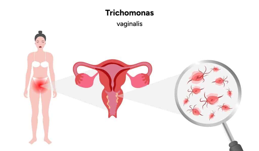 trikomoniaza, infeksionet vaginale seksualisht te transmetueshme