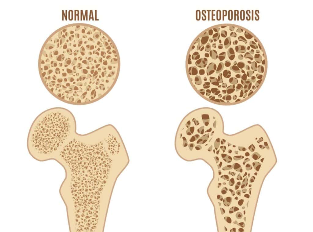 shenjat e degradimit kockor nga osteoporoza