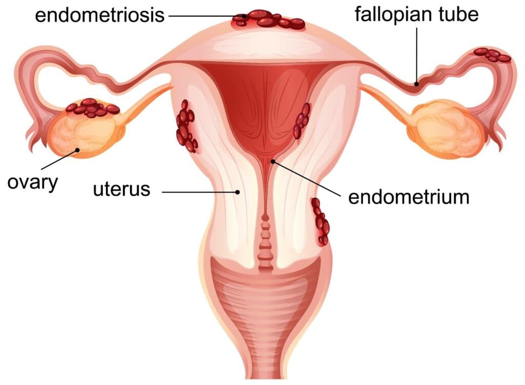 crregullimi i endometriozes
