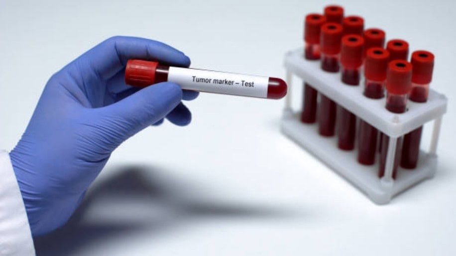 Mjek duke analizuar rezultatet e tumor markerave (PSA, CA-125, CEA) për diagnostikim të hershëm dhe kontroll onkologjik