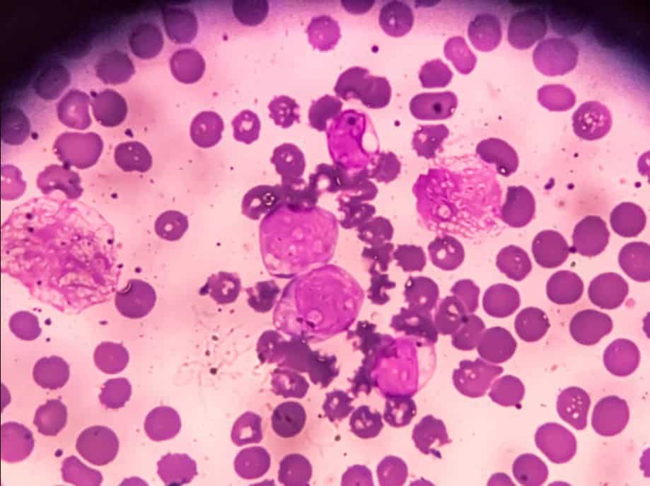 Testime laboratorike për tumor marker që përdoren në kontrollet parandaluese dhe monitorimin e shëndetit