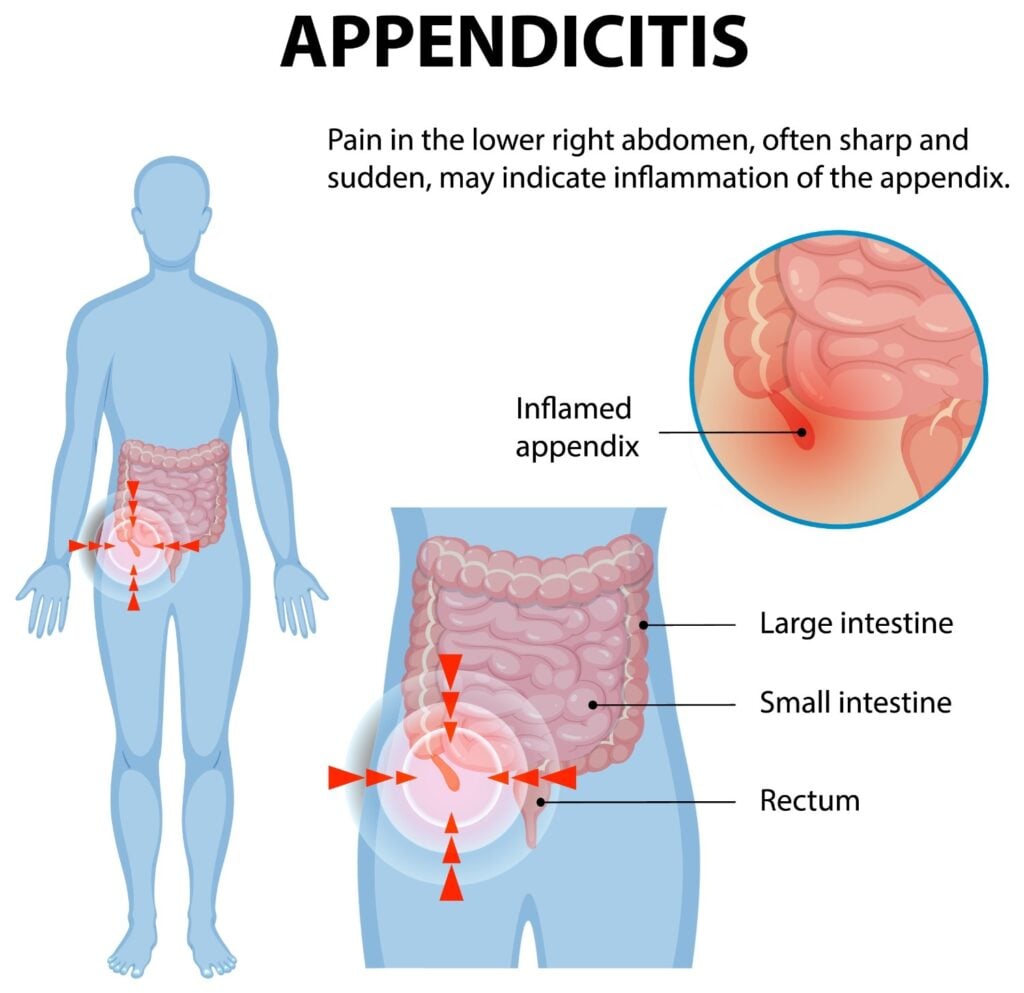 shenjat e apendicitit